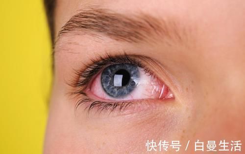 肝脏|肝不好“眼”先知!一旦眼睛有这2种“迹象”,很有可能是肝癌!