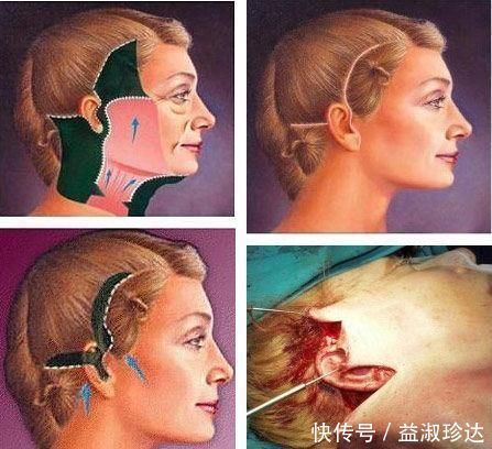 皮肤|聊一聊除了拉皮手术,微创小切口提升怎么样?多大年纪适合做?