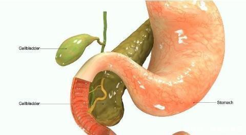 胆结石|胆结石是由什么诱因引起的此4个坏习惯,需及时纠正,勿忽视