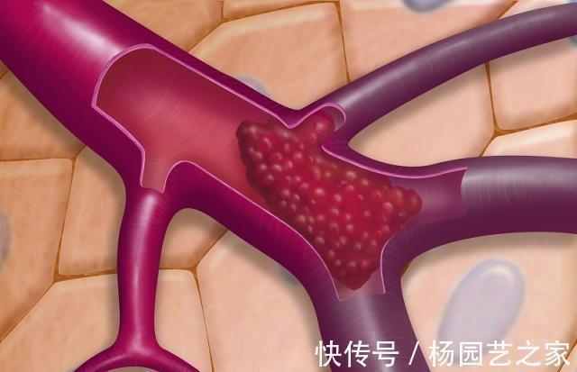 黑木耳|得了血栓先别慌,多吃3种天然“阿司匹林”,有助于清理血管垃圾