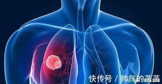 吸烟|肺癌一发现都是晚期错早期往往有蛛丝马迹,是身体在向你求救