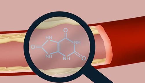  张先生|男子尿酸608，三个月后降回正常值，他的方法是什么？值得学习