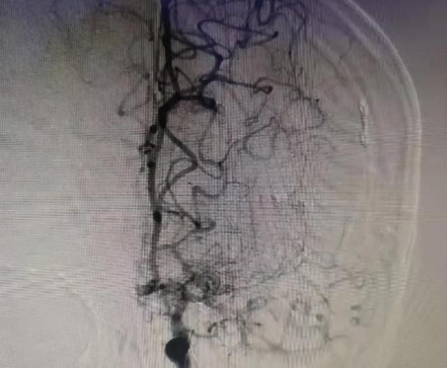 烟雾|多年来总头晕，发作三两天就好！医生一查：脑袋里“少根儿筋”