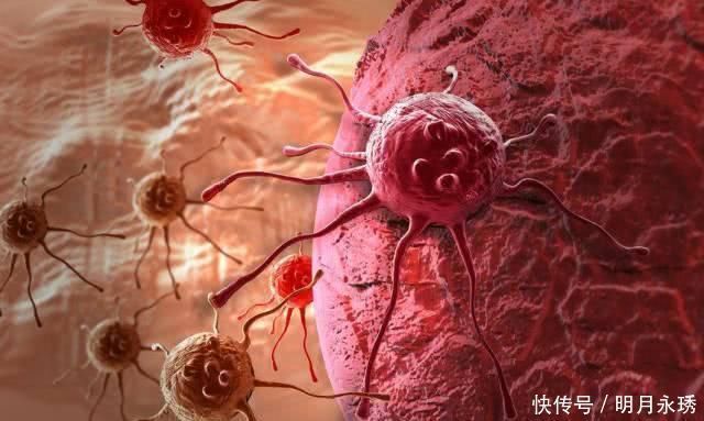 癌变|放屁多、臭就是肠癌提醒真正需要警惕起来的，是这三个症状