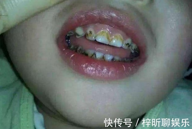 食物|4岁孩子满嘴都是“小黑牙”,结果不是因为糖,而是家长无知!