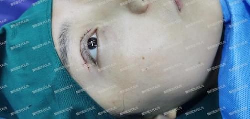 38岁做了眼周年轻化手术,看我眼周的变化,给计划做的人一个参考