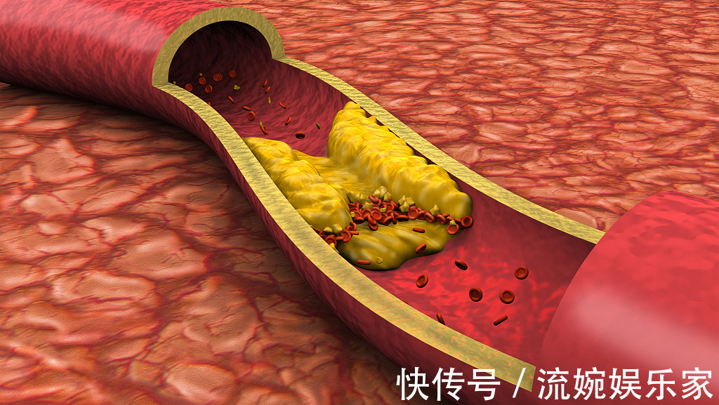 中老年人|高血脂患者身体有6种“面相”,不想病情加重,多吃5种食物