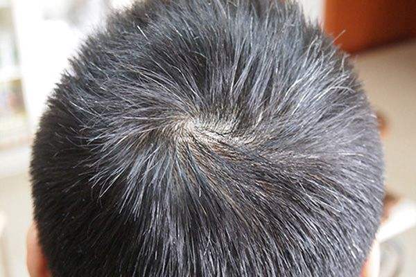 中医|“早生白发”最好用的方子,2味中药泡茶饮,补虚又乌发