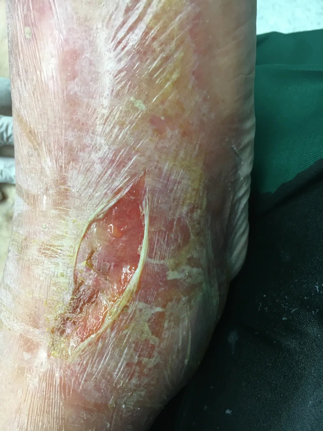 细菌|一只梭子蟹，宁波大叔差点截肢丧命！这种“吃进去”的细菌太可怕