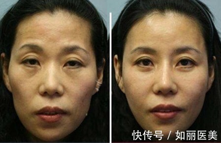 填充 面部填充脂肪多长时间能恢复自然状态?价格&术后攻略送你参考!