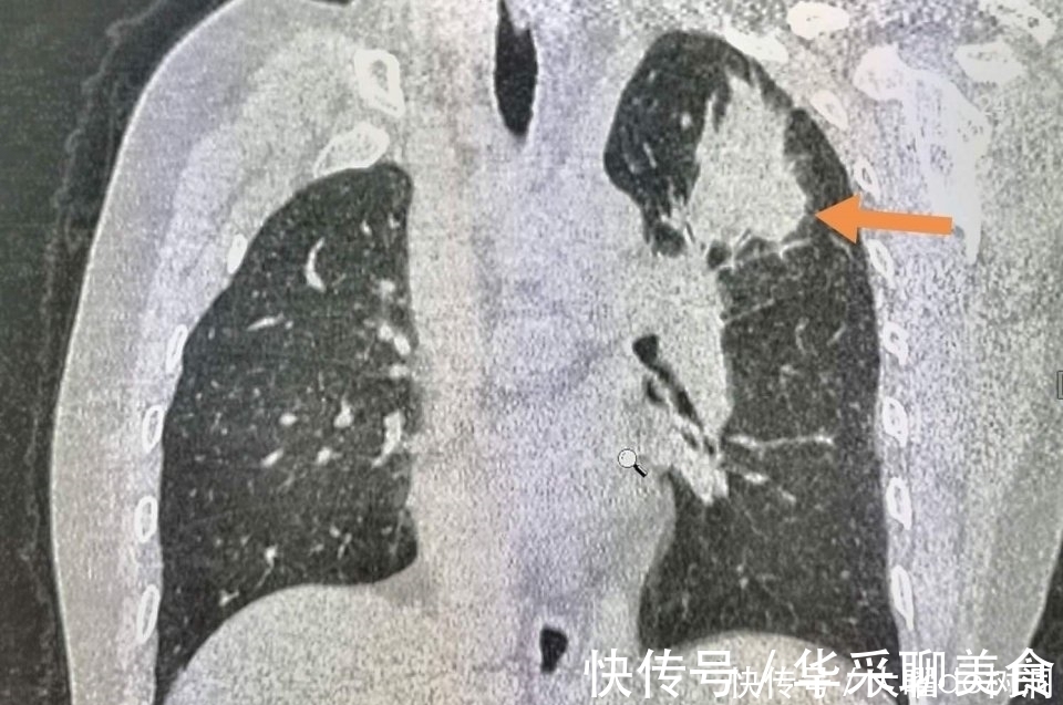 体检|年年体检，为什么还得了晚期肺癌？体检有啥用！