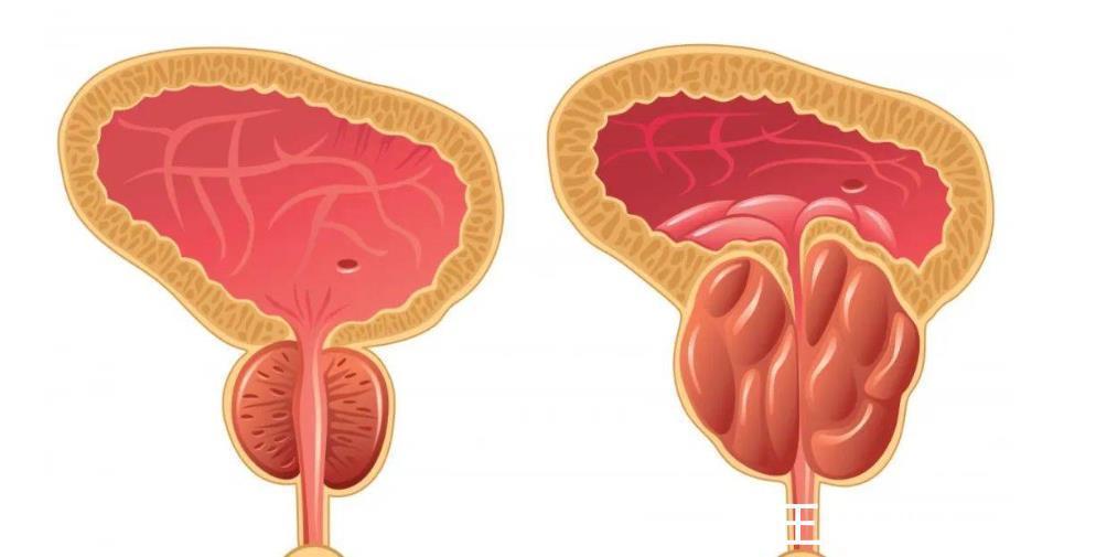恶性肿瘤|患上这三种癌,是不幸中的万幸合理治疗,或能够好好活着