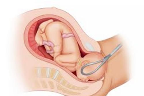产钳|“医生,能别用产钳吗?”产妇忍痛换跪姿分娩,为母则刚很感人