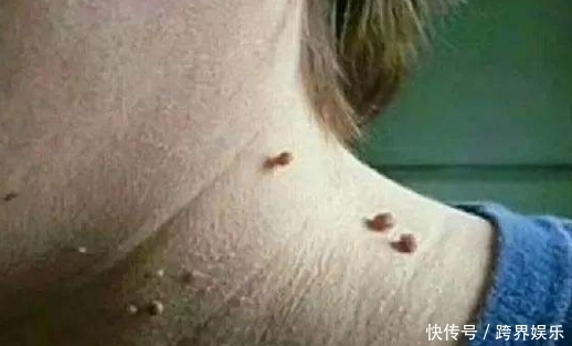 激素水平|脖子上的“小肉疙瘩”是什么?可能与3个原因有关