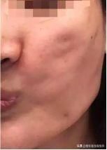线雕6个月后脸仍旧凹凸不平，问题出在哪？还能救吗？