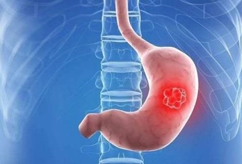 食物|有胃炎可以吃虾吗?提示:想要远离胃病,建议少碰这3种伤胃食物