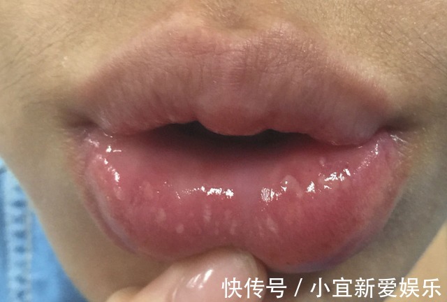 身体|嘴上长泡是身体在排毒吗？或许是暗示了这几个问题，别忽视