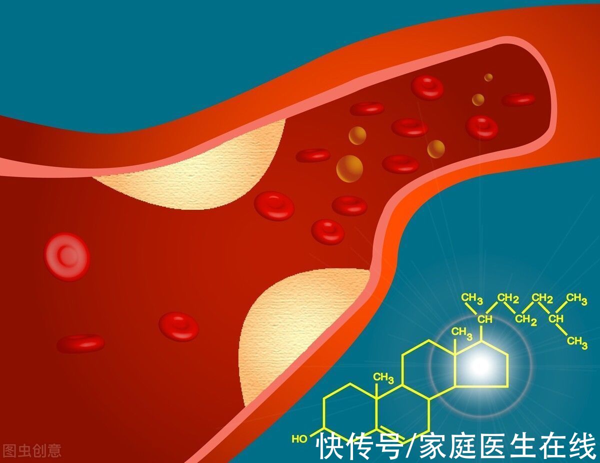 动脉|体内有个“不定时炸弹”？关于斑块的5个知识，建议提前了解一下