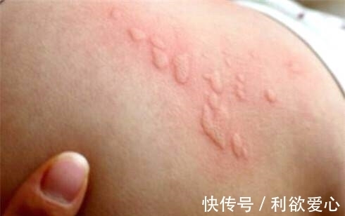 小狗狗|5岁孩子总说浑身很痒,医生仔细一检查,结果发现一物想要呕吐