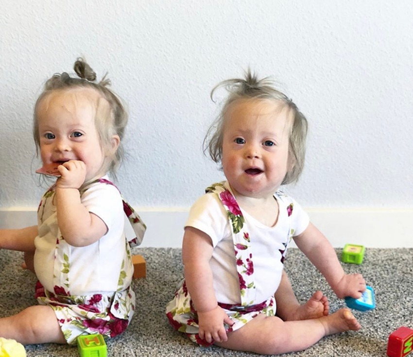 病症|产妇生下唐氏双胞胎姐妹,并没有放弃,网友唐宝都有一张国际脸