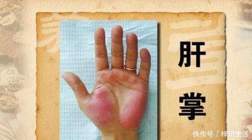 预防肝硬化|天然“强肝王”被发现，不想肝透支就多吃，肝硬化或“不告而别”