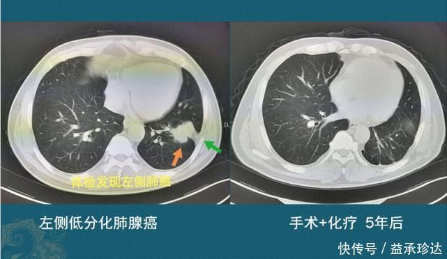 放化疗|查出癌症不放疗不化疗，保持良好心态吃喝玩乐，能扛过去吗