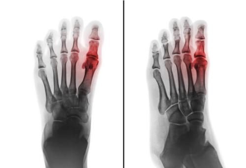 嘌呤|辟谣——“尿酸高”就是有“痛风”？要尽快降尿酸？医生：并不是