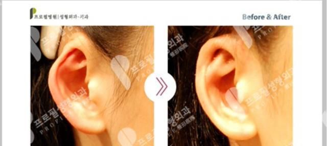 整容|医生，我耳朵不够精灵