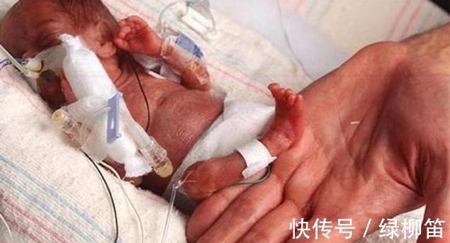 早产儿|''拇指姑娘''出生时仅25厘米,被诊断活不到1岁,结果却出人意料
