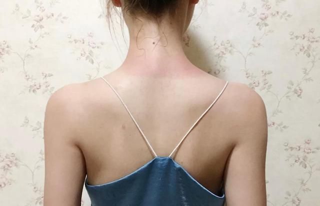 夏日|女生夏日护肤,比防晒更重要的是:晒后修复!这才是“变黑”原因