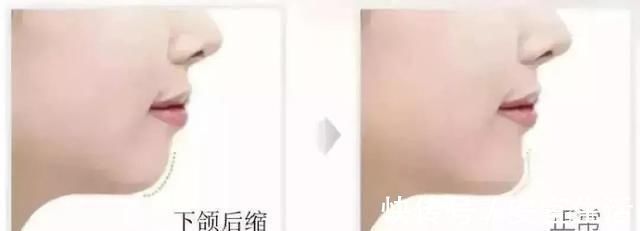 畸形|父母請注意：孩子12歲之前必須矯正的幾種牙齒畸形