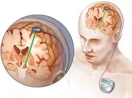 脑起搏器|60岁柳州阿姨被帕金森病困扰十年，医生为她植入脑起搏器“重启人生”