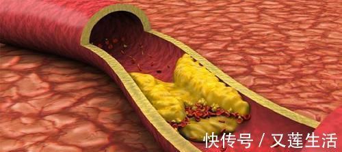 降血脂|天然“他汀”放1勺,连喝15天,专攻高血脂、疏通血管、血栓不来