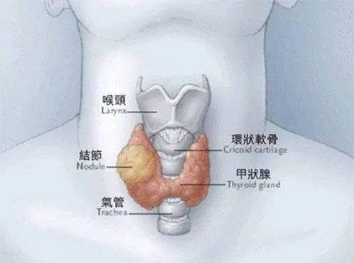 结节|打工人体检频现「甲状腺结节」，是时候揭开真相了