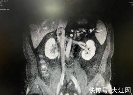 刘飞|南昌大学二附院泌尿外科成功完成一例肾癌根治+下腔静脉II级癌栓取出术