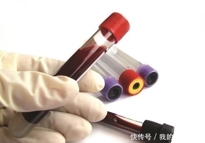 服用阿司匹林|人到中年每天服用阿司匹林，能起到预防颈动脉斑块发生的作用吗？