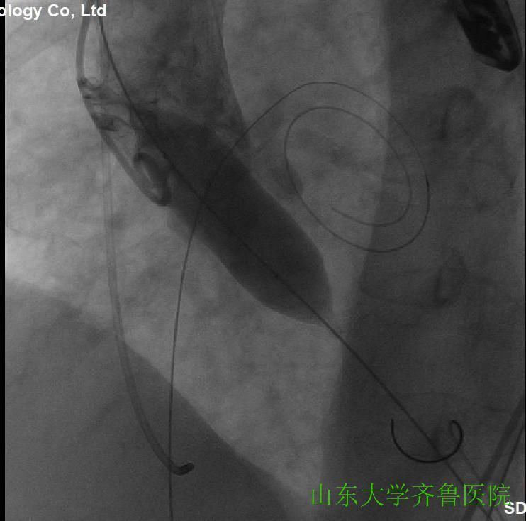 患者|省内首例!齐鲁医院完成一站式经导管主动脉瓣置换术(TAVR)+经皮二尖瓣球囊扩张成形术(PBMV)