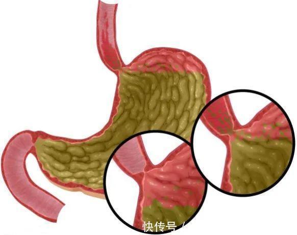 腌菜|4类食物比较伤胃，冬季养胃，避免4个行为，不妨了解一下