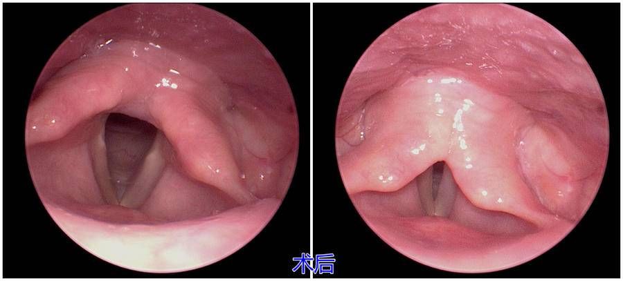 耳鼻喉科|显微镜下声带息肉切除术，还“声嘶”患者“好声音”