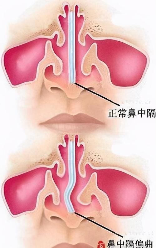 鼻中隔|为什么孩子容易感冒？这和儿童的鼻腔结构有关