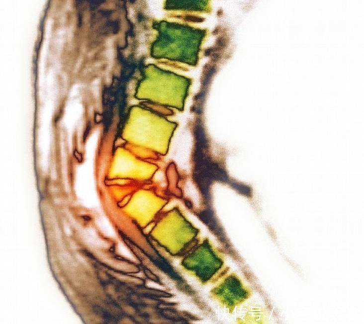 骨質(zhì)疏松的癥狀有哪些？吃什么食物可預(yù)防骨質(zhì)疏松？