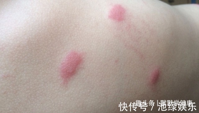 阳气|利用肚脐眼养阳,照着这样做提升阳气,秋冬少生病!