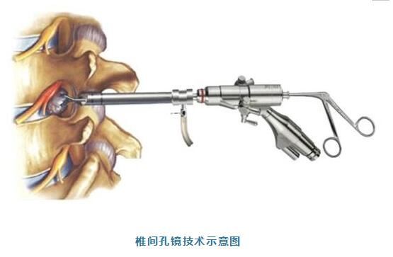 微创|微创局麻孔镜技术，快速解决腰椎间盘突出的疼痛烦恼