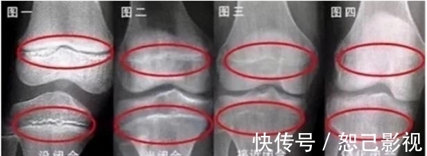 身高|12岁女孩身高145cm,医生:孩子若有两个特征,预示骨垢线要闭合