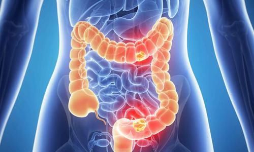  患者|排便若有这5种表现，多半是肠癌发出的求救信号，趁早进行检查