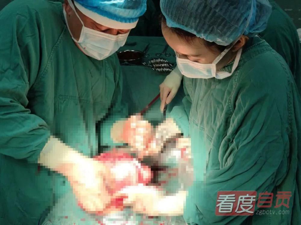 自贡市妇幼保健院妇|女子腹大如“怀孕” 手术取出肿瘤重达······