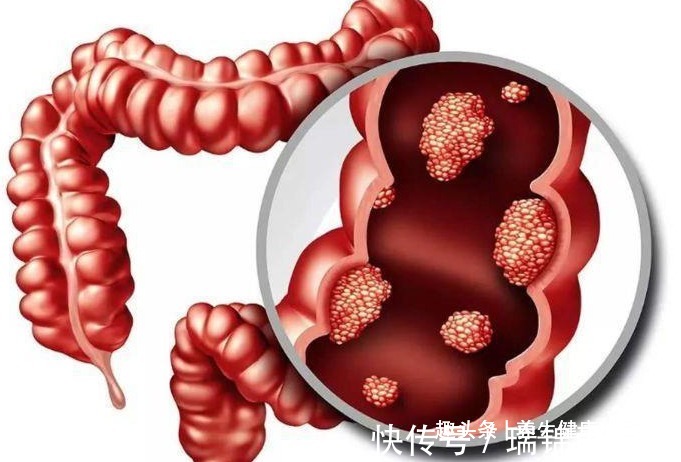 平胃散|一个只有四味药的中药方,能消除一切息肉,值得你收藏!