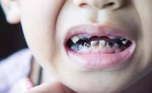 3岁孩子满嘴“小黑牙”,医生:不是因为糖,都是父母的“无知”