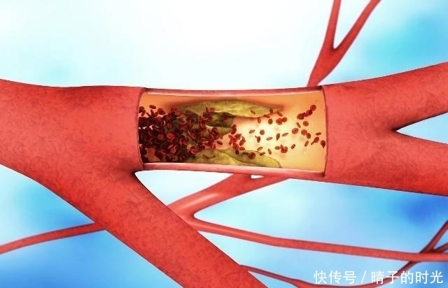 动作|血栓最怕这个动作,每天只需10秒,躺着就能做,助你远离血栓!