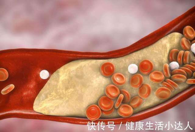 金兰菊根茶|血脂多高才算是高?身体出现5个信号,要开始降脂养血管了